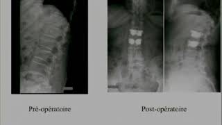 Fractures vertébrales en compression traitées par stentoplastie [upl. by Aitam]