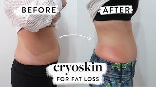 I Tried Cryoskin for Fat Loss And Toning  Susan Yara [upl. by Ittap853]