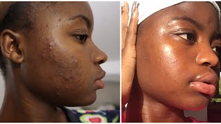 Bilan 2 mois Traitement curacnéroaccutane Accutane Treatment Peau noiredark skin [upl. by Tiffi167]