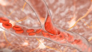 Ischemic Stroke [upl. by Joo]