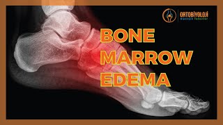 BONE MARROW EDEMA TREATMENTS [upl. by Goldner]