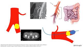 Acute Limb Ischemia [upl. by Asina387]