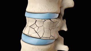 Back Surgery  Vertebroplasty and Kyphoplasty  Nucleus Health [upl. by Lucrece832]