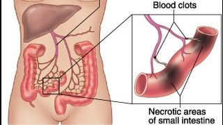 Mesenteric Ischemia [upl. by Ashton72]