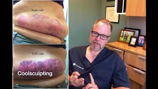 Sculpsure vs Coolsculpting  Which One is Better [upl. by Acirne]