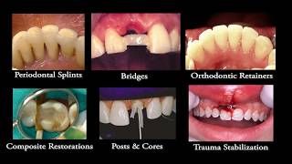 What is Ribbond Features Benefits FAQ’s [upl. by Asserat]