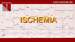 ECG Ischemia [upl. by Sicnarf]