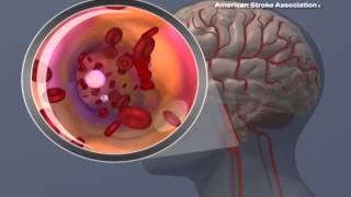 Ischemic Stroke Animation [upl. by Adnauqaj]