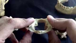 first cervical vertebra  The atlas [upl. by Lyrehs259]